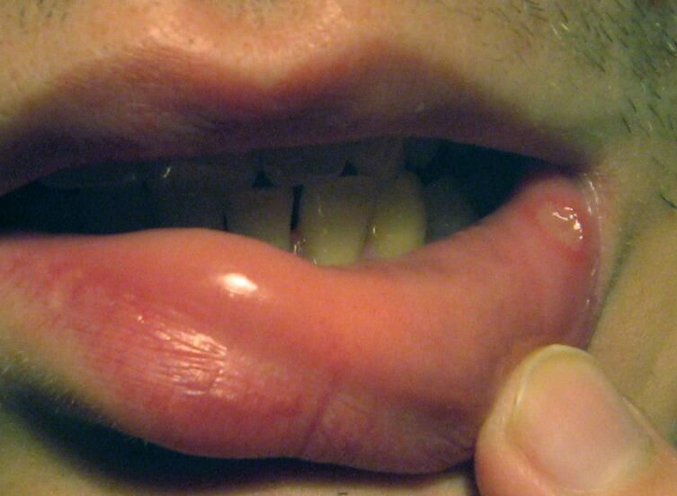 Стоматит на внутренней части губы