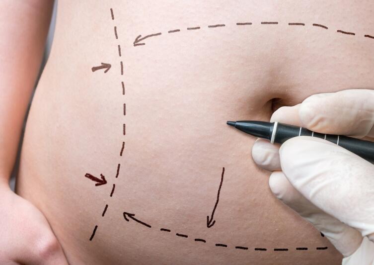 Как подтянуть кожу на животе после родов? Методы борьбы с растяжками