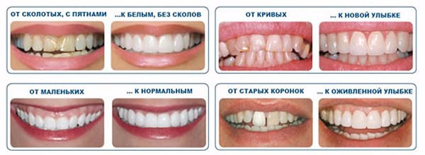 Виниры на зубы. Что известно о художественной реставрации зубов? | STENA.ee
