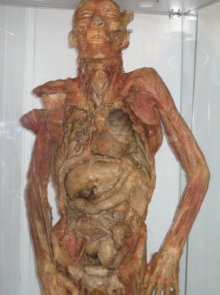 Экспонат целого тела, пластинированный силиконом для Эстонского музея здравоохранения