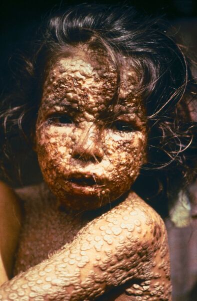 Девочка из Бангладеш, больная натуральной оспой,1973 г.