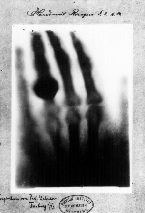 Первый рентгеновский снимок, рука Анны Берты Людвиг, жены ученого