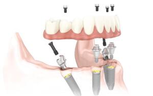 Имплантация зубов методом «All-on-four» (Все на четырех)