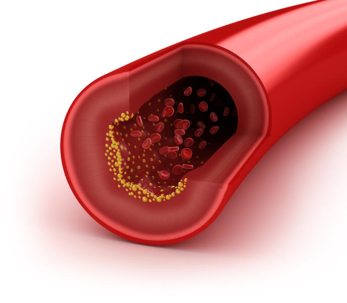 В крови холестерин содержится и в чистом виде, и «упакованным» в специальную протеиновую оболочку